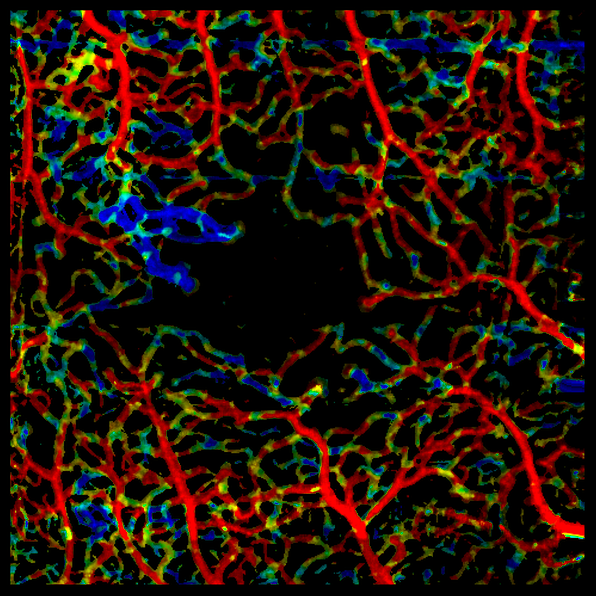 Variable Interscsan Time Analysis (VISTA) revealing slower blood flow in neovascularization in a PDR patient.