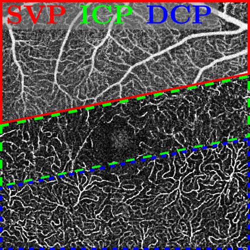 Advanced shadow artifact removal reveals the unique structures of the superficial vascular plexus (SVP), the intermediate capillary plexus (ICP) and the deep capillary plexus (DCP)